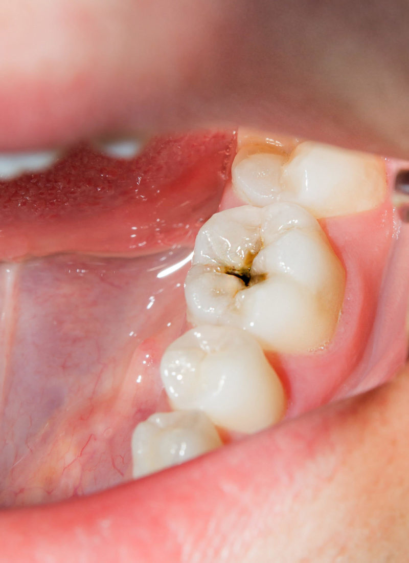What is a Dental Cavity